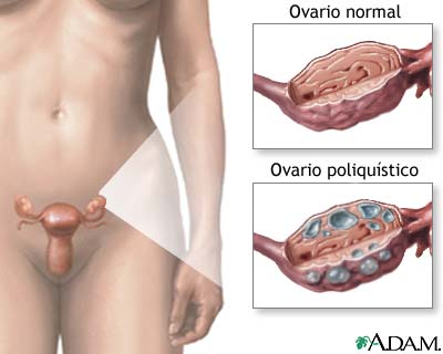 como quedar embarazada con ovarios poliquisticos